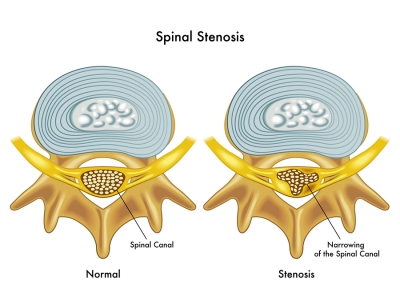 noraml spine compared to a spine with spinal stenosis